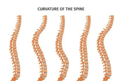 living with kyphosis